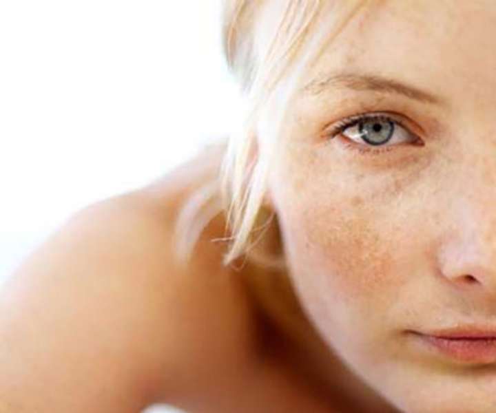 Nguyên nhân cốt lõi của sạm nám, tàn nhang và kinh nghiệm điều trị từ Lasmar